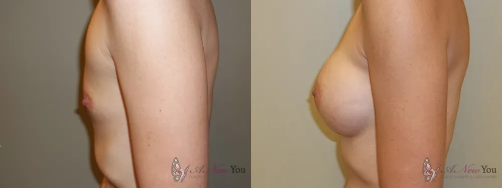 breast-augmentation-30a-ba2
