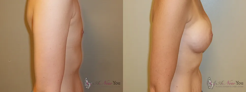 breast-augmentation-30a-ba3