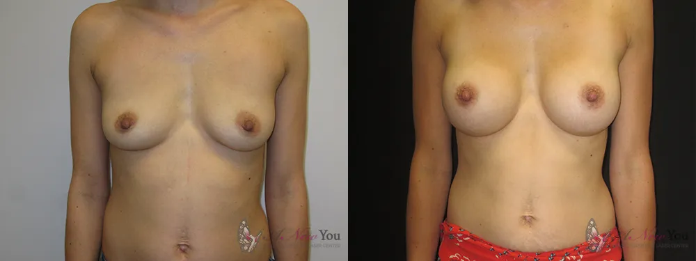 breast-augmentation-31a-ba1