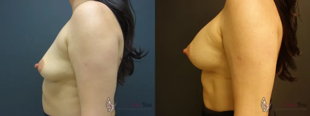 breast-augmentation-32a-ba2