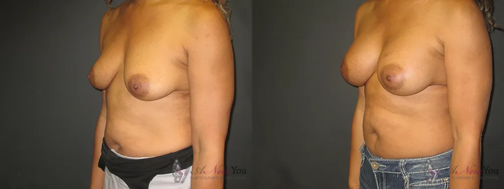 breast-augmentation-33a-ba2