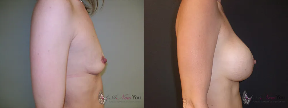 breast-augmentation-34a-ba2