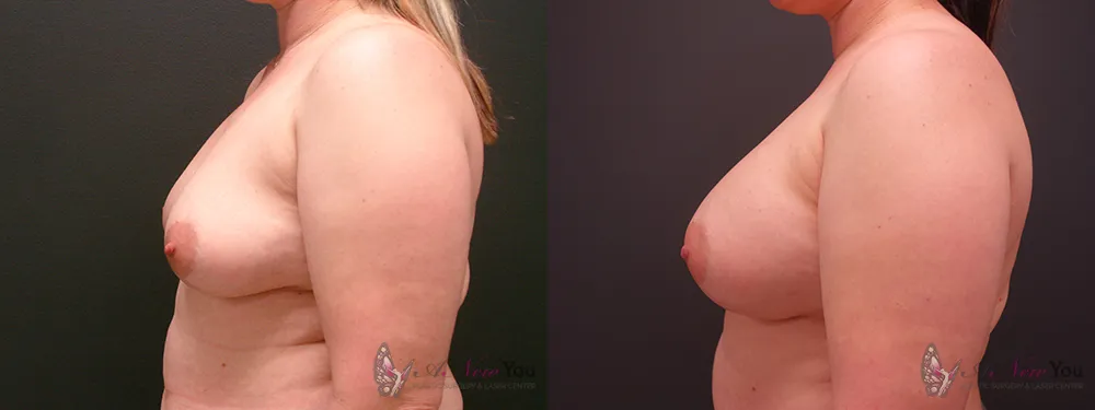 breast-augmentation-35a-ba2