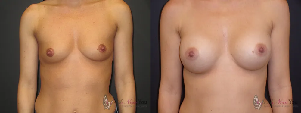 breast-augmentation-36a-ba1