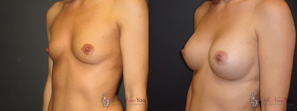 breast-augmentation-36a-ba2