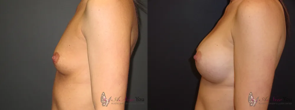 breast-augmentation-36a-ba3