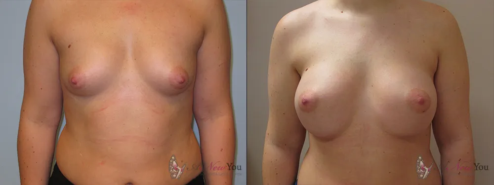 breast-augmentation-37a-ba1