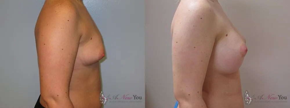 breast-augmentation-37a-ba2