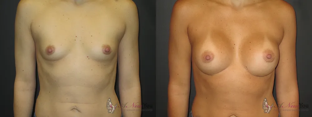 breast-augmentation-38a-ba1