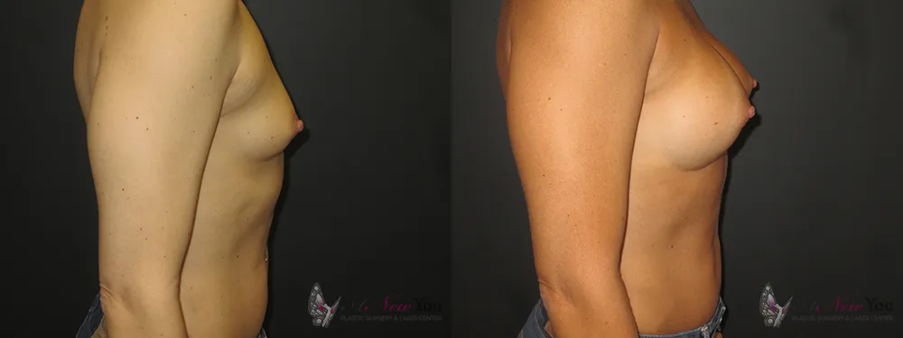 breast-augmentation-38a-ba4