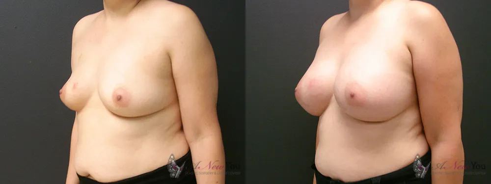 breast-augmentation-39a-ba2