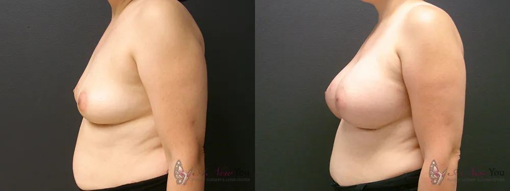 breast-augmentation-39a-ba3