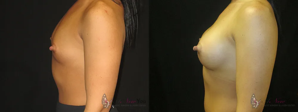 breast-augmentation-40a-ba2