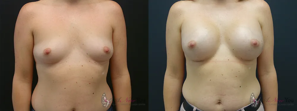 breast-augmentation-42a-ba1