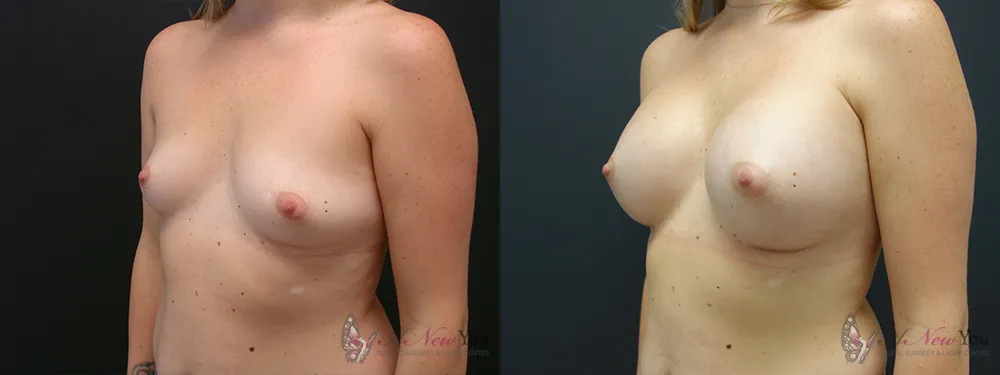 breast-augmentation-42a-ba2