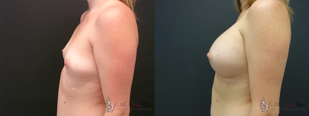 breast-augmentation-42a-ba3