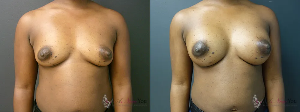 breast-augmentation-43a-ba1