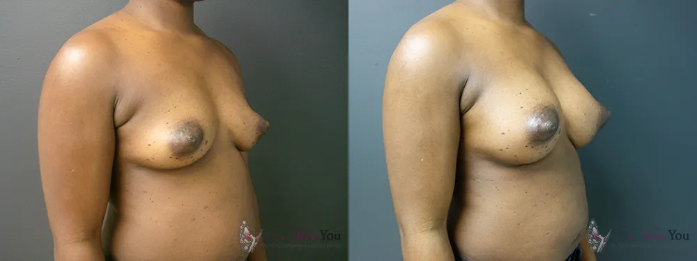 breast-augmentation-43a-ba2