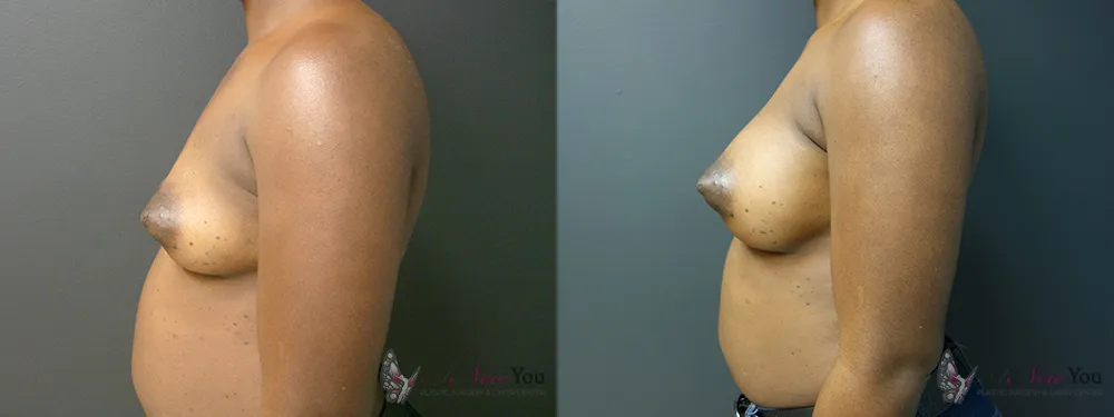 breast-augmentation-43a-ba3