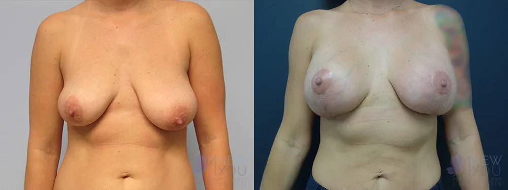 breast-augmentation-44a-ba1