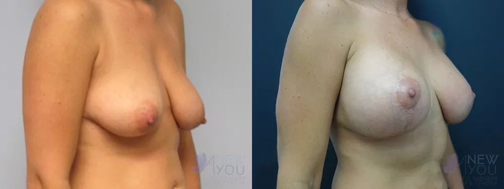 breast-augmentation-44a-ba2