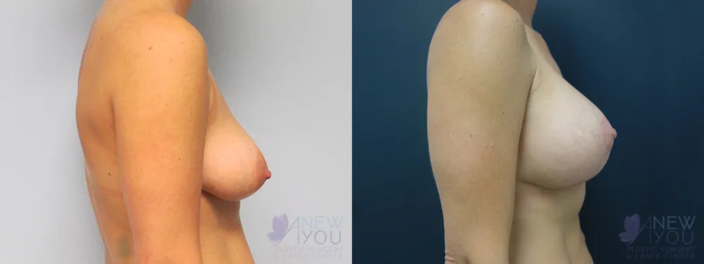 breast-augmentation-44a-ba3