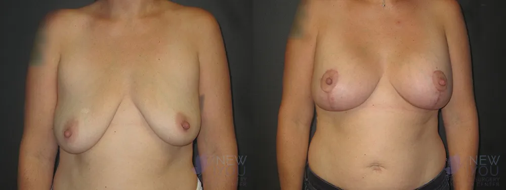breast-augmentation-45a-ba1