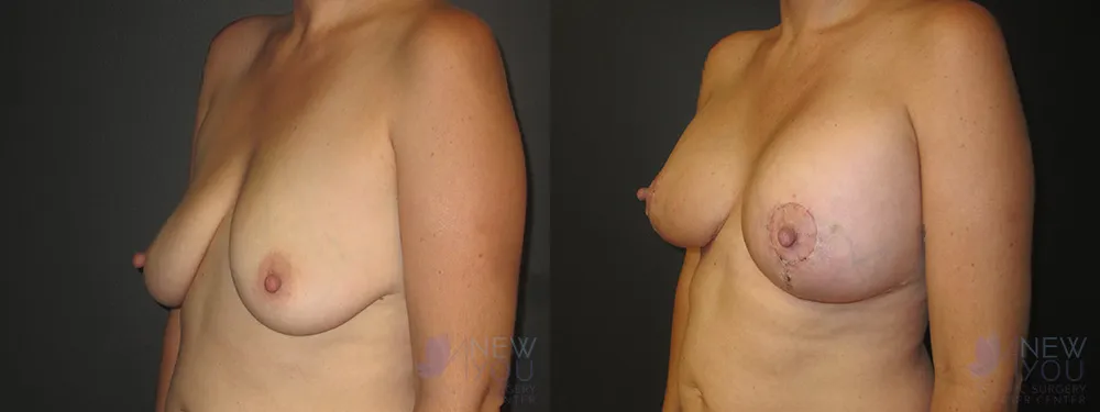 breast-augmentation-45a-ba2