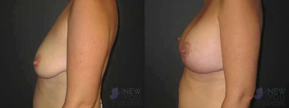 breast-augmentation-45a-ba3