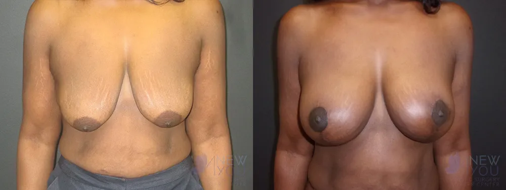 breast-augmentation-46a-ba1
