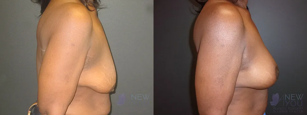 breast-augmentation-46a-ba2