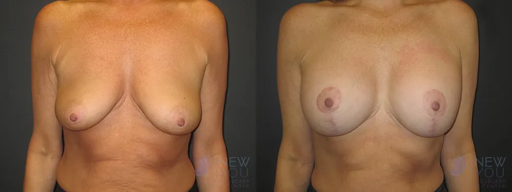 breast-augmentation-47a-ba1