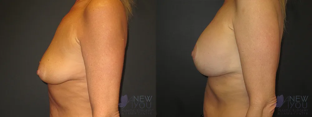 breast-augmentation-47a-ba2