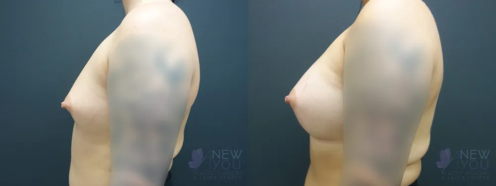 breast-augmentation-49a-ba3