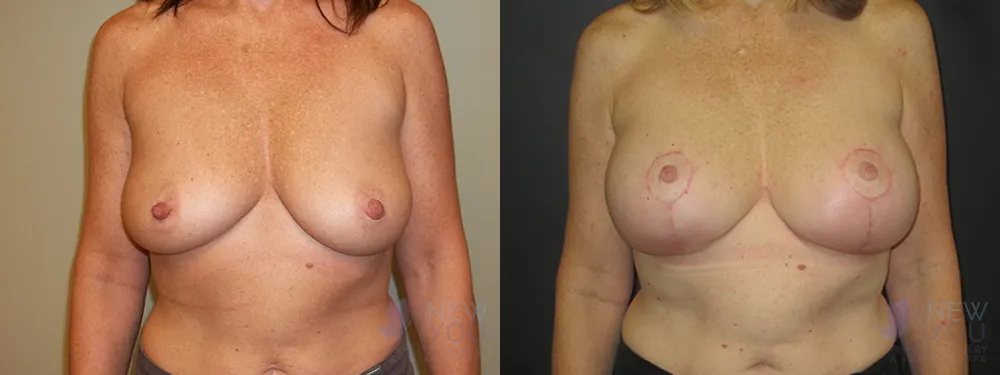 breast-augmentation-50a-ba1