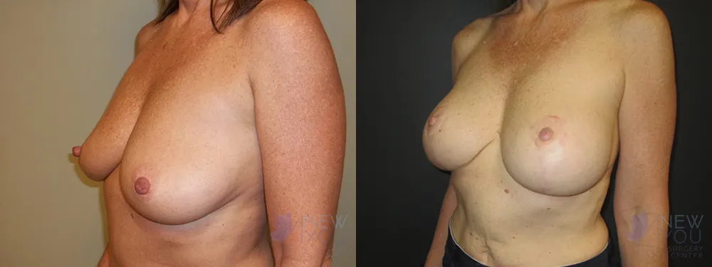 breast-augmentation-50a-ba2