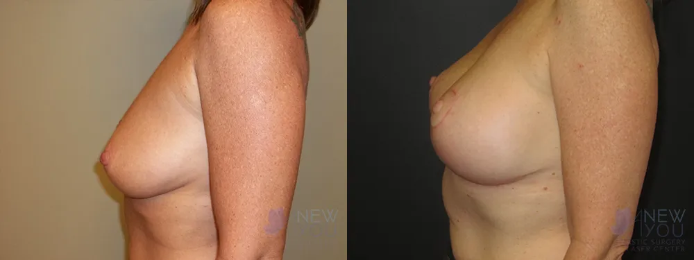 breast-augmentation-50a-ba3