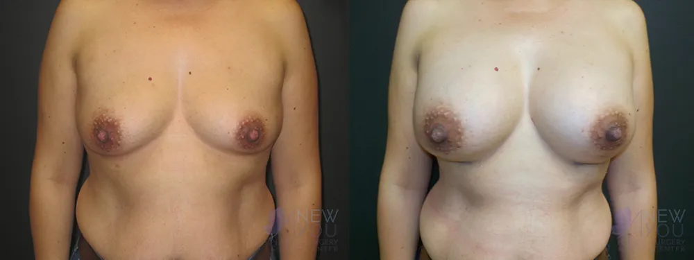 breast-augmentation-51a-ba1