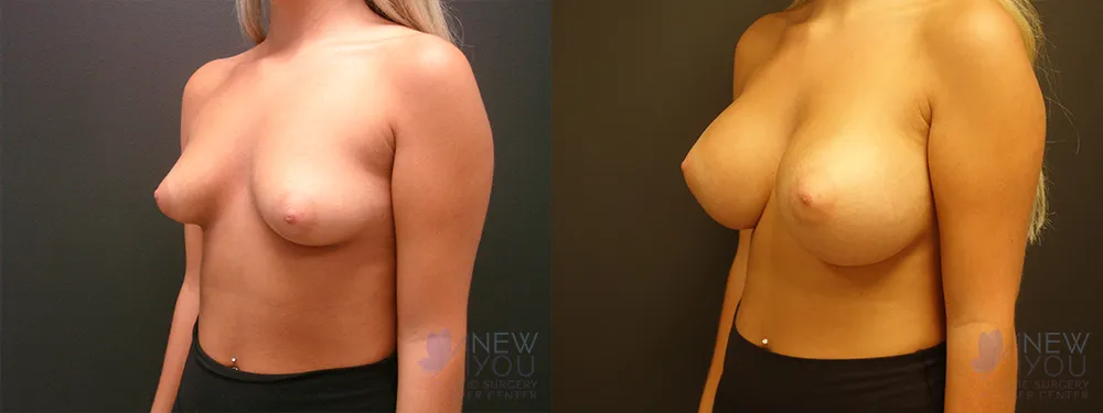 breast-augmentation-52a-ba2