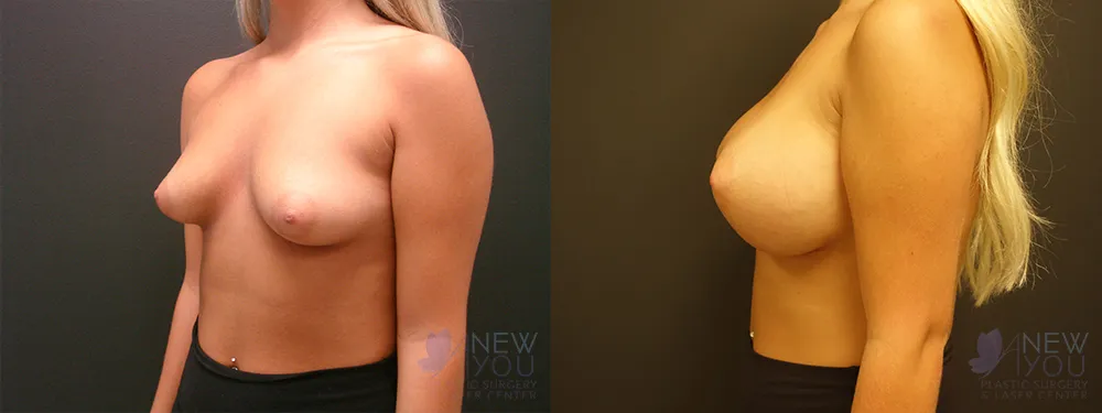 breast-augmentation-52a-ba3