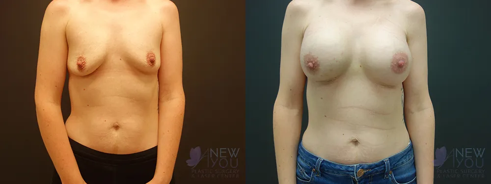 breast-augmentation-53a-bA1