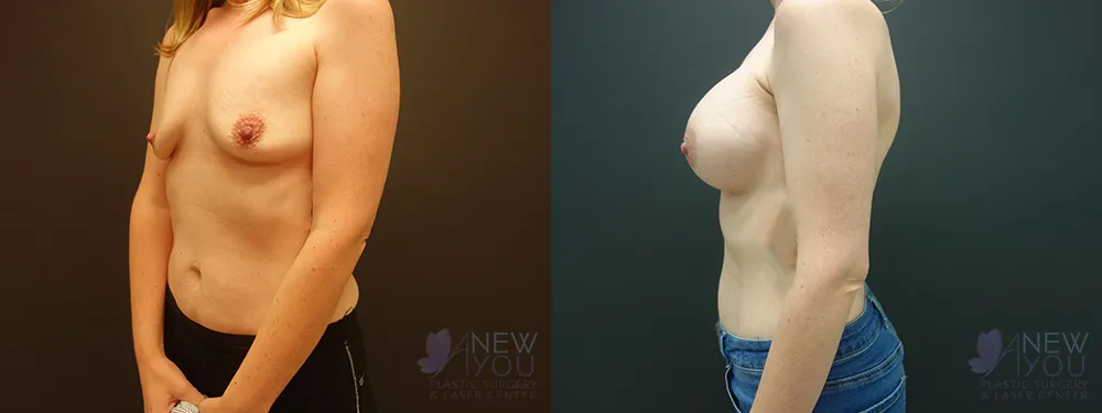 breast-augmentation-53a-bA3