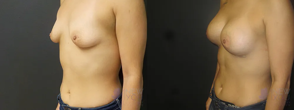 breast-augmentation-56a-bA2