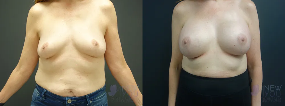 breast-augmentation-57a-bA1