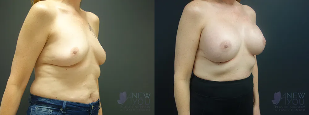 breast-augmentation-57a-bA2