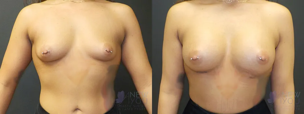 breast-augmentation-59a-ba1