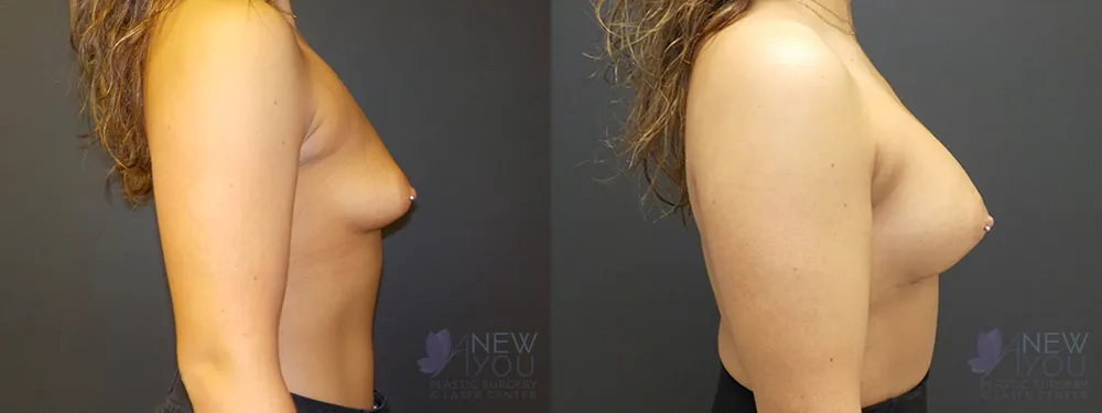 breast-augmentation-59a-ba2