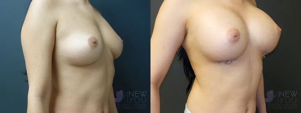 breast-augmentation-60a-ba2