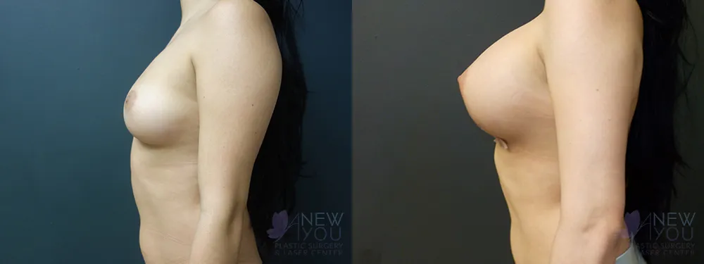 breast-augmentation-60a-ba3