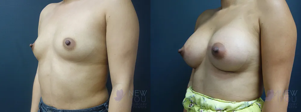 breast-augmentation-61a-ba2